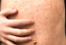 Haïfa déclarée “foyer national” de rougeole : le ministère de la Santé tire la sonnette d’alarme