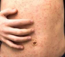 Ministère de la Santé : un enfant d’un an non vacciné contre la rougeole est décédé des suites de complications