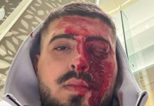 L’israélien violemment agressé à Chypre après avoir parlé hébreu a perdu la vue