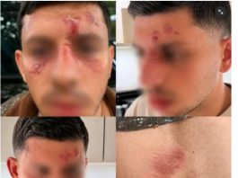 Shalom Beniakar attaqué à Londres : « Ils m’ont demandé si j’étais juif. Ils m’ont frappé et ont tenté de me déshabiller »