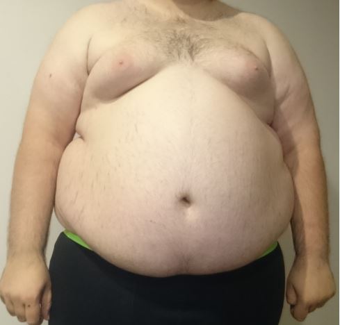 obesite wikipedia