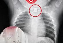 Assuta Ashdod | LES MÉDECINS NE POUVAIENT PAS EXPLIQUER LA TOUX DU BÉBÉ : Puis une radiographie a révélé la cause choquante