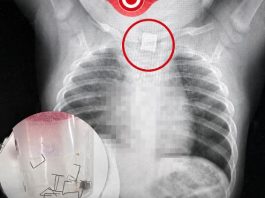 Assuta Ashdod | LES MÉDECINS NE POUVAIENT PAS EXPLIQUER LA TOUX DU BÉBÉ : Puis une radiographie a révélé la cause choquante