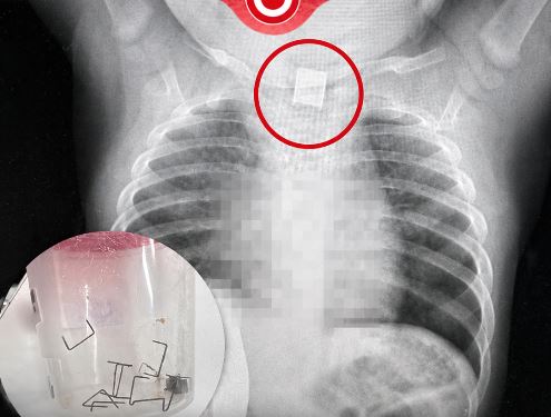 Assuta Ashdod | LES MÉDECINS NE POUVAIENT PAS EXPLIQUER LA TOUX DU BÉBÉ : Puis une radiographie a révélé la cause choquante